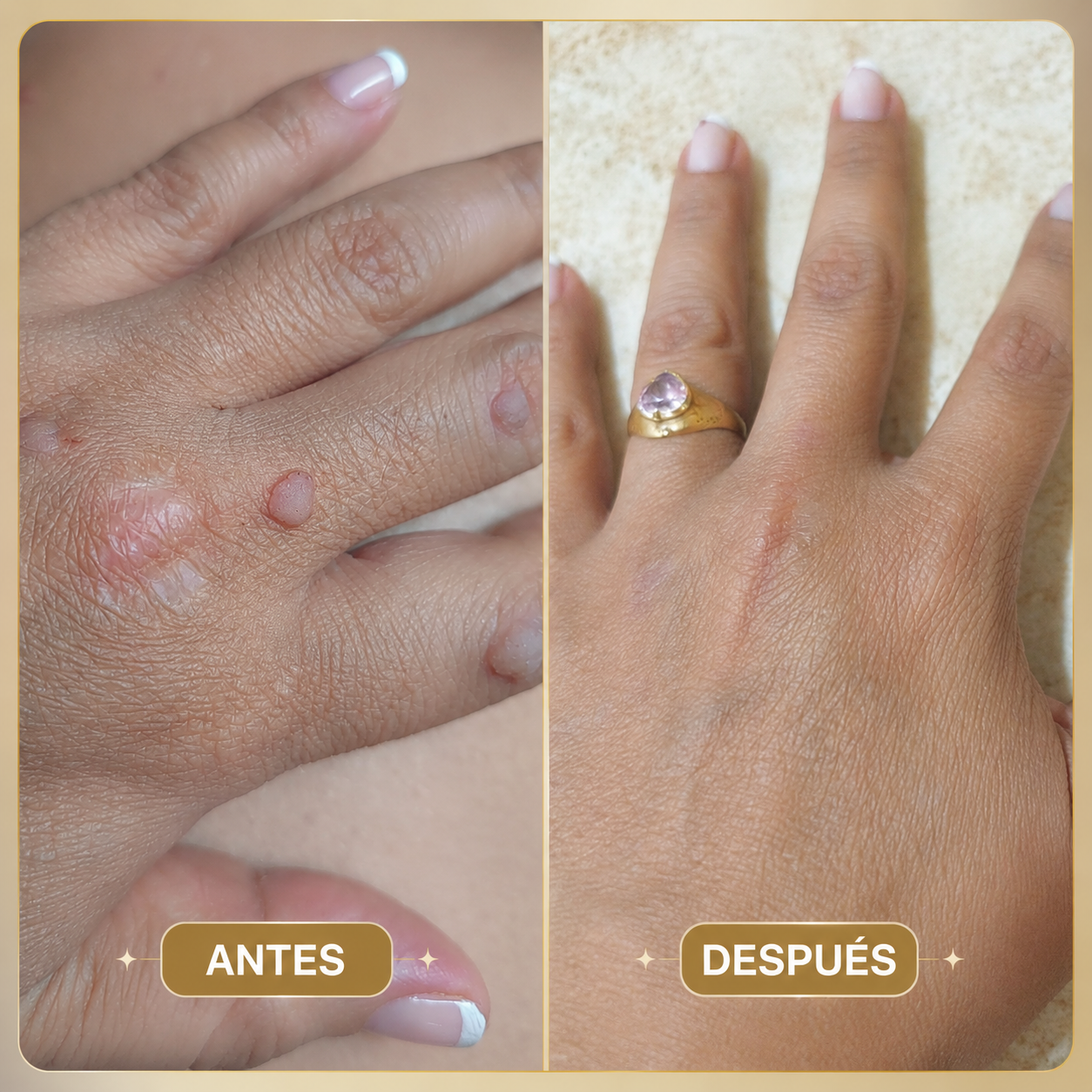 AMU DERMA  Eliminador Localizado de Imperfecciones