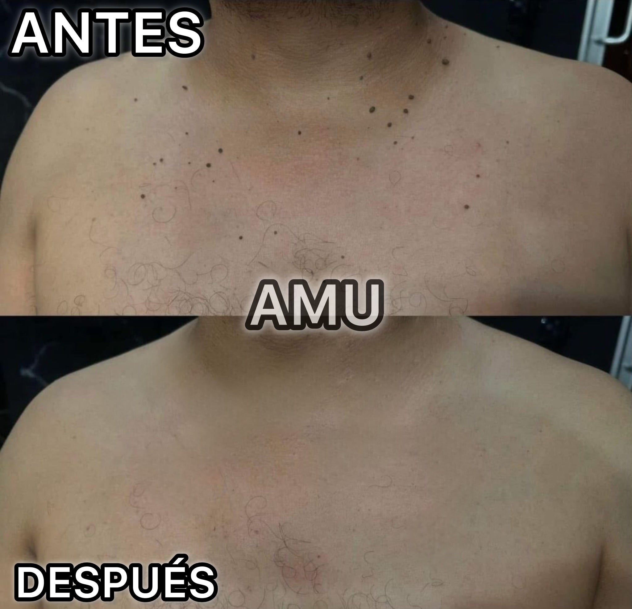 AMU DERMA  Eliminador Localizado de Imperfecciones