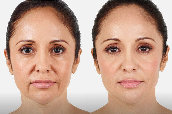 Botox Suero Antiarrugas Skinvia